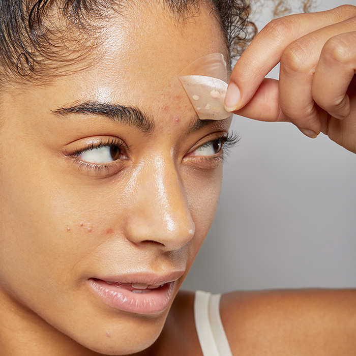 do pimple patches work